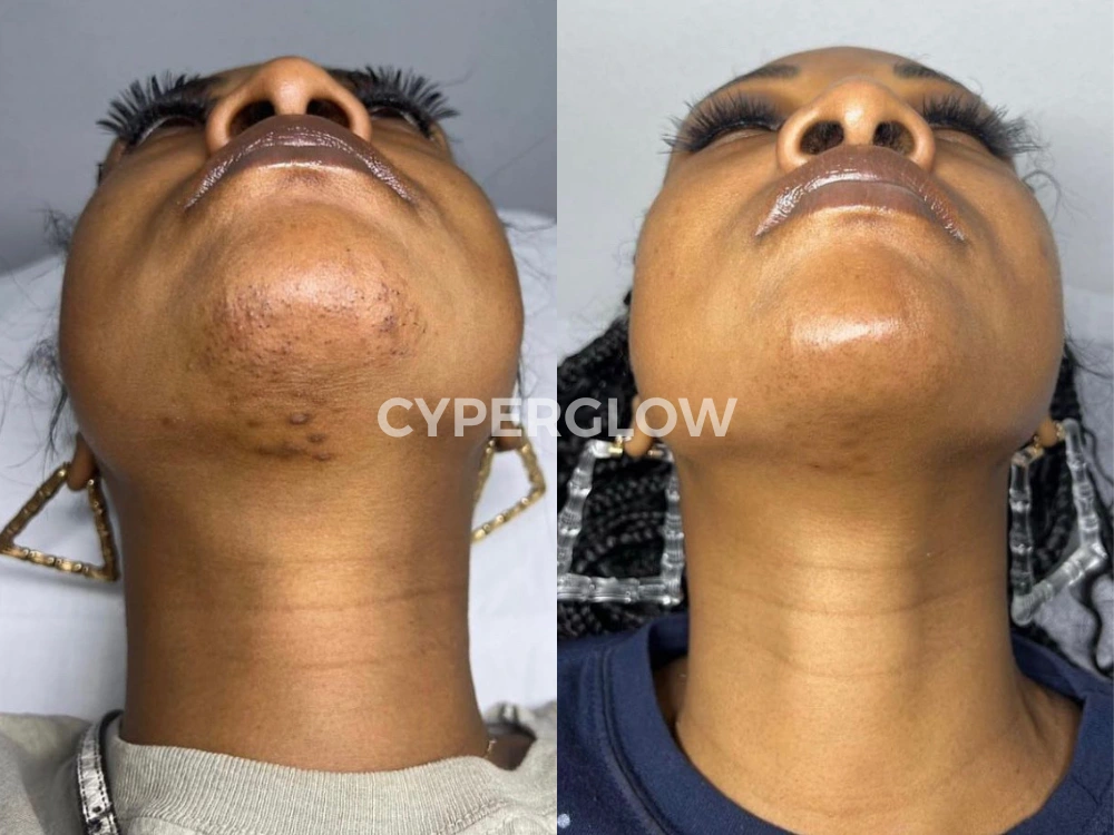 Chin and neck paired photographs published with Keisha S. review